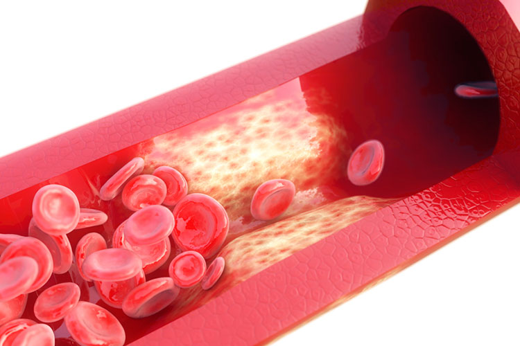 動脈硬化